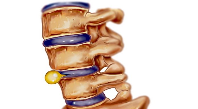 Doctorul Ümit Kepoğlu: Hernia de disc – cauze şi simptome
