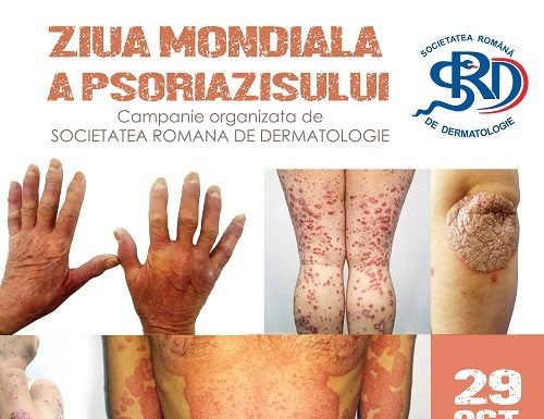 Psoriazisul, a 5-a cea mai importantă boală cronică netransmisibilă