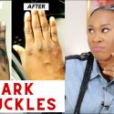 Dark Knuckle Whitening Elbow And Knee Brightening Serum In Nigel And Saldanha Town Call +27710732372